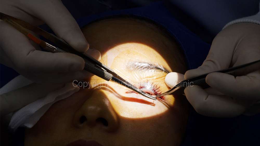 เย็บแผลหลังผ่าตัดถุงใต้ตา
